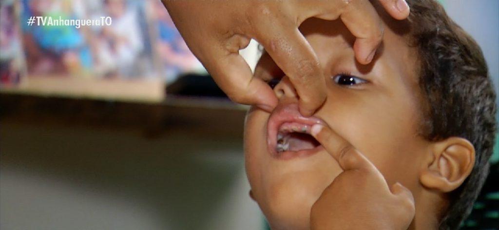 Menino que precisa extrair todos os dentes tem cárie severa e dificuldades para se alimentar: ‘Emagreceu muito rápido’, diz mãe