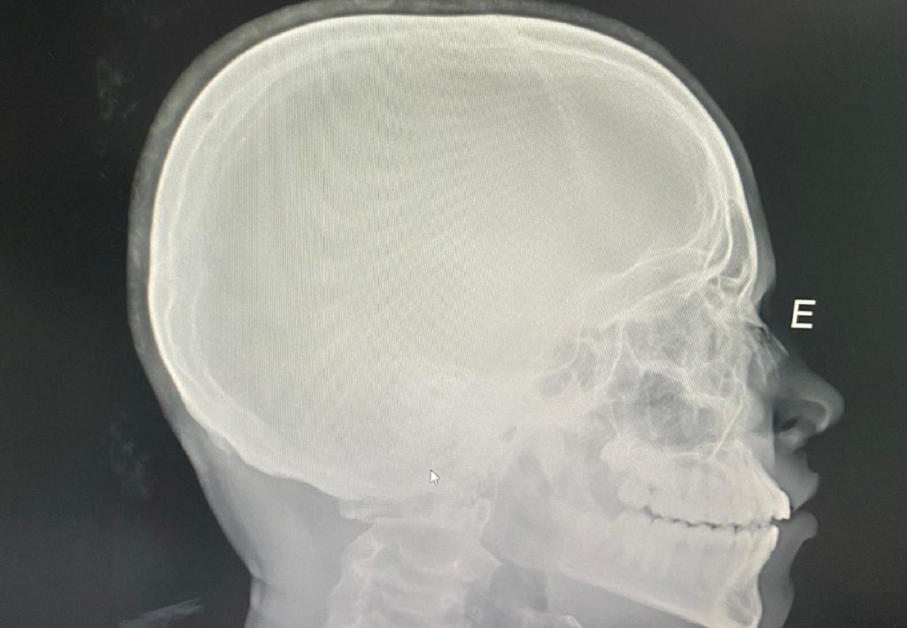 Estudante tem nariz quebrado após sofrer ofensas racistas e agressão em escola pública do Tocantins