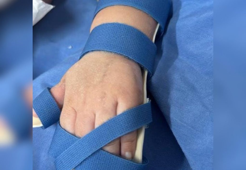 Estudantes criam suporte sob medida para ajudar na reabilitação de criança em hospital no TO